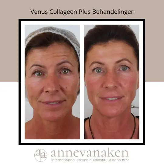 before en after van collageen behandeling annevanaken in Den Haag