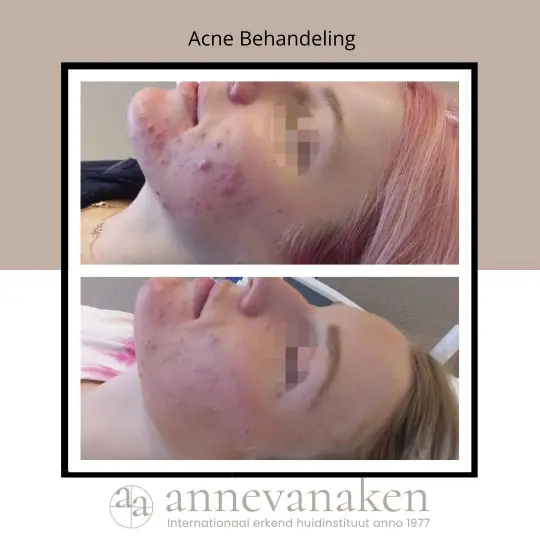 Resultaten acne behandeling bij annevanaken in Den Haag